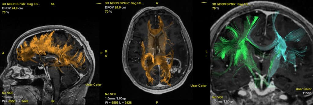Brain DTT - Awake surgery