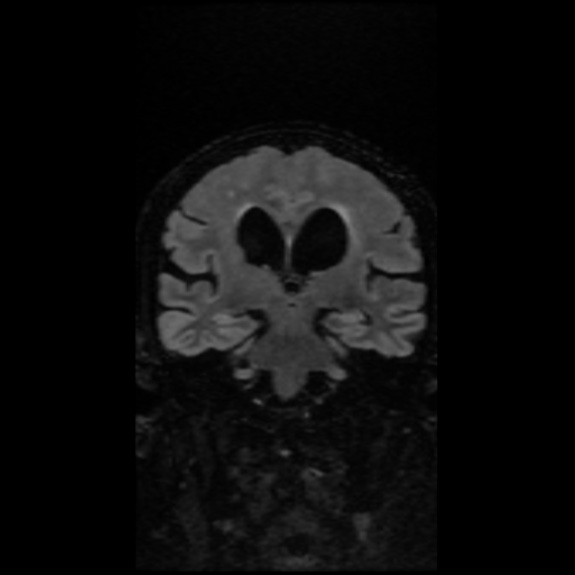 RMN encefalo FLAIR (sezione coronale) suggestiva di idrocefalo normoteso (NPH)